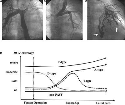 Pulmonary Arteriovenous Fistulae After Fontan Operation: Incidence, Clinical Characteristics, and Impact on All-Cause Mortality